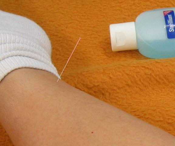 Akupunktur-Nadel und Desinfektionsmittel